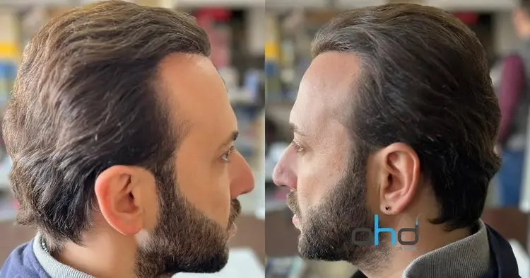 Après une greffe de cheveux