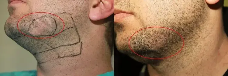 200 beard grafts were transplanted onto the cheek area