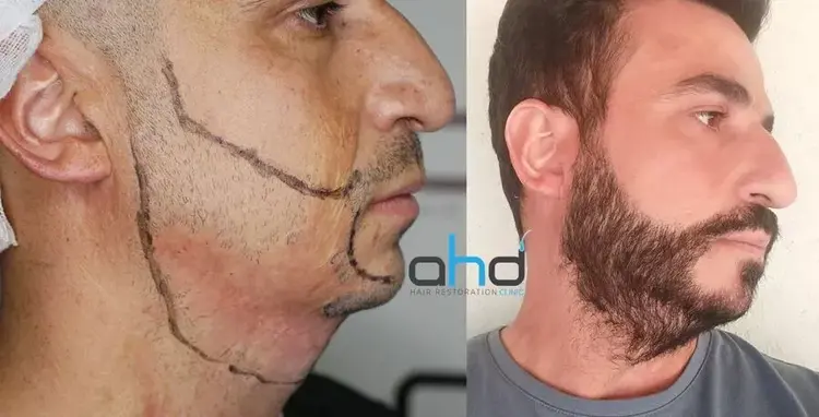 After his beard transplant, the man with the burned face is very happy