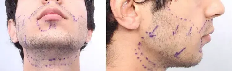 For a natural result in beard transplantation, the directions and angles must be correct