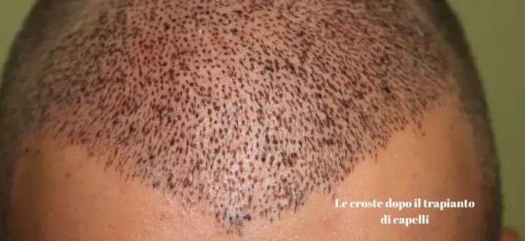 Dopo il trapianto di capelli, la formazione di croste può durare fino a 10 giorni.