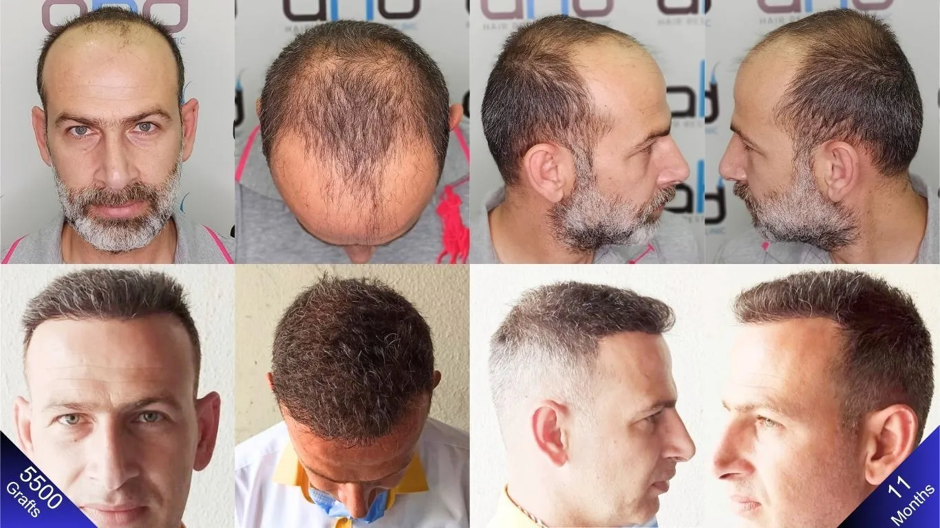 كيف تبدو عملية زراعة الشعر بـ ٥٥٠٠ طعمة في تركيا؟ هذا هو الجواب الذي تبحث عنه.

