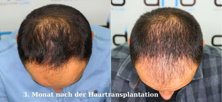 Der dritte Monat nach der Haartransplantation