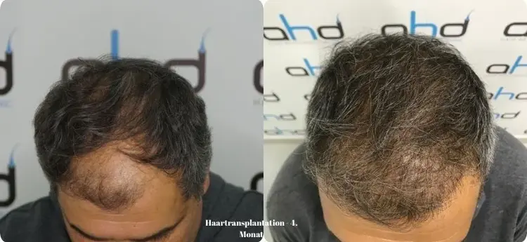 Haartransplantation-Der-4.-Monat