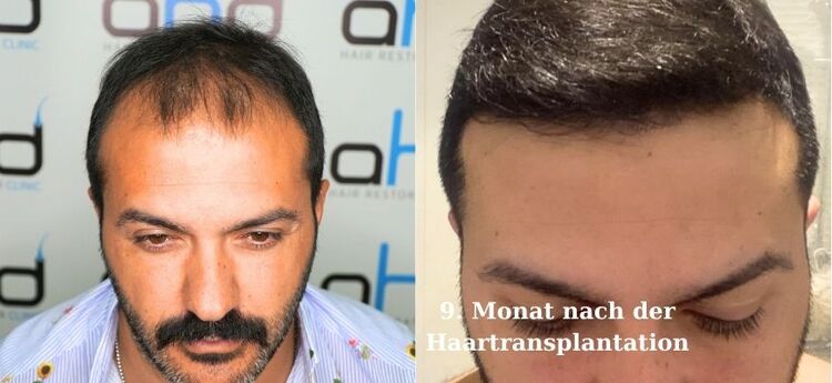 Haartransplantation – der 9. Monat