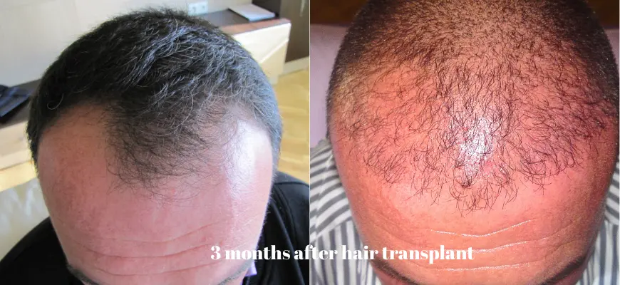 3 months hair transplant