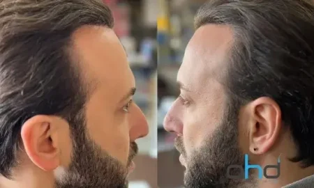 Il processo post-trapianto_di_capelli