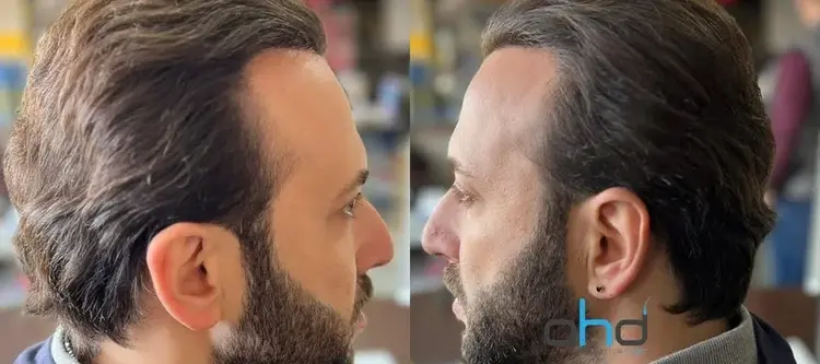 Il processo post-trapianto_di_capelli