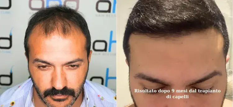 9 mesi prima e dopo il trapianto di capelli, risultati straordinari.