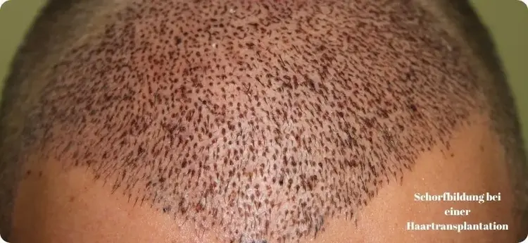 Die Krustenbildung ist ein normaler Teil des Heilungsprozesses nach einer Haartransplantation
