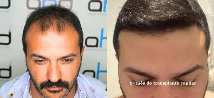Resultado incrível antes e 9 meses após o transplante capilar