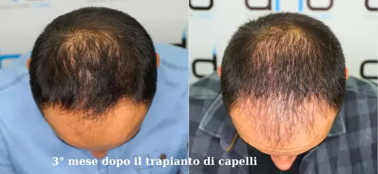 Immagine a 3 mesi dopo il trapianto di capelli