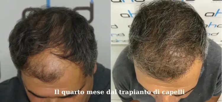 Trapianto-di-capelli-dopo-4-mesi