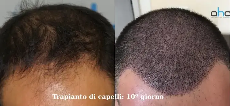 Immagine a 10 giorni dal trapianto di capelli