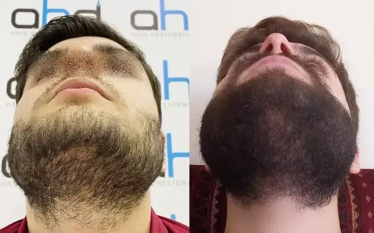Very good results can be achieved through the densification process in beard transplantation