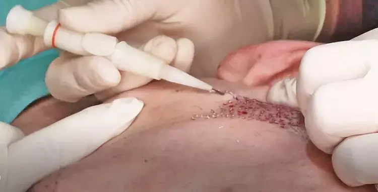 The most optimal outcomes in beard transplantation are obtained using the DHI technique.