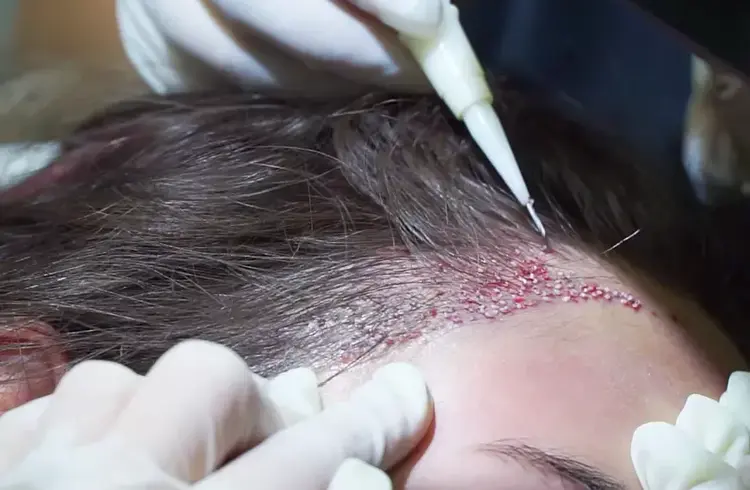 You can see the hair transplant procedure for women using the DHI method in the picture