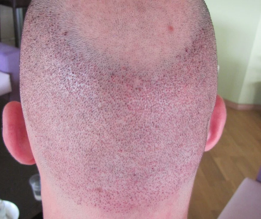 Donor area 1st day after hair transplant