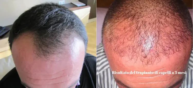 dopo-3-mesi-dal-_trapianto-di-_capelli