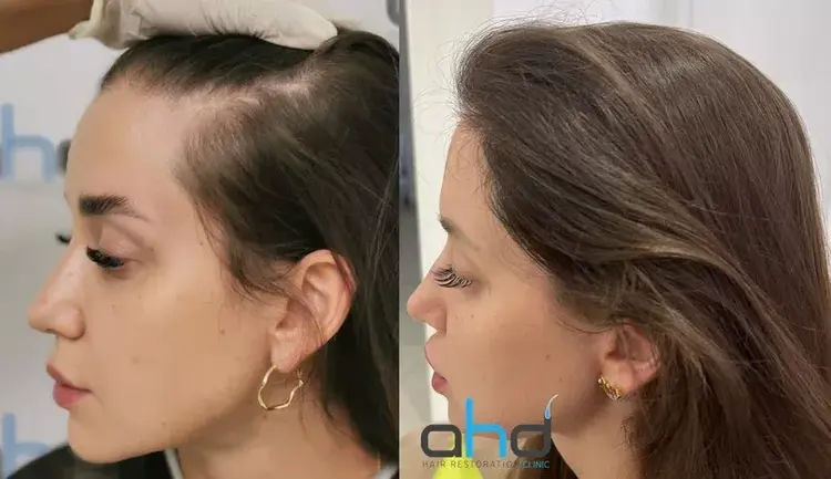 greffe cheveux femme avant/après
