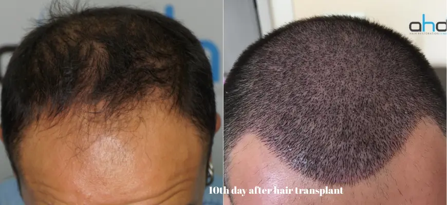 10-day hair transplant image