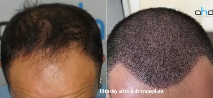 10-day hair transplant image