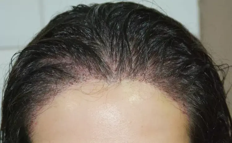 Linha do cabelo da mulher
