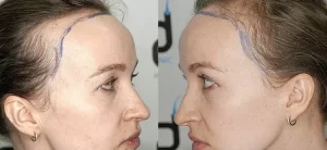 mujer con trasplante de cabello