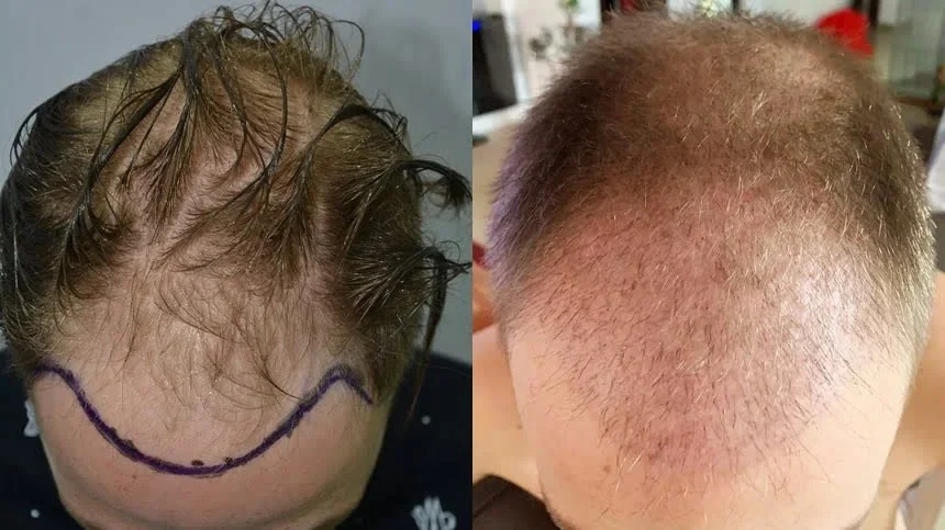 iki aylık şok dökülme dönemi