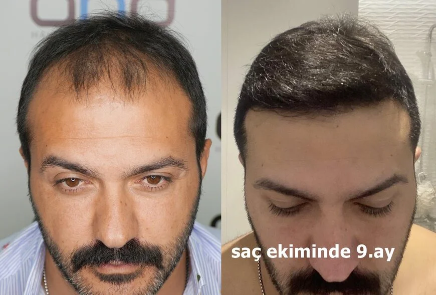 9 aylık saç ekimi