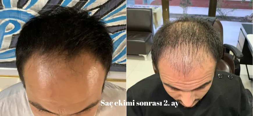 saç ekiminde 2 ay