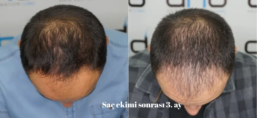 3 aylık saç ekimi
