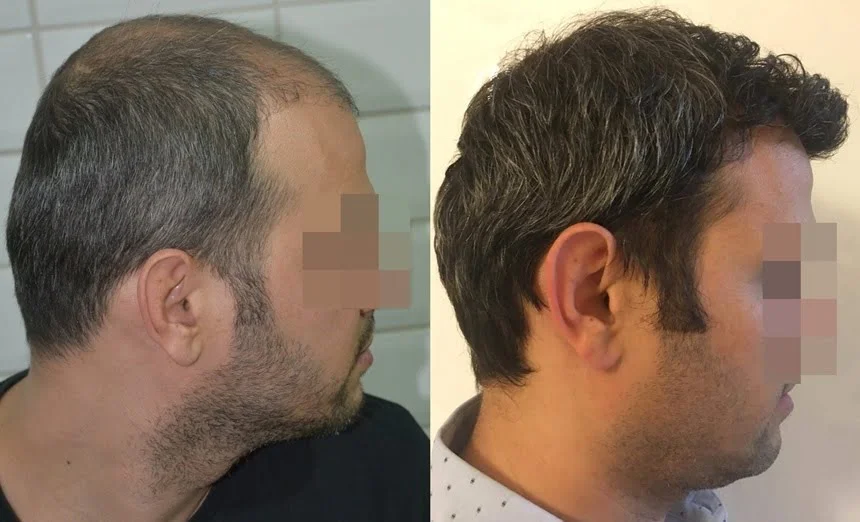 saç ekimi 12 aylık sonuç