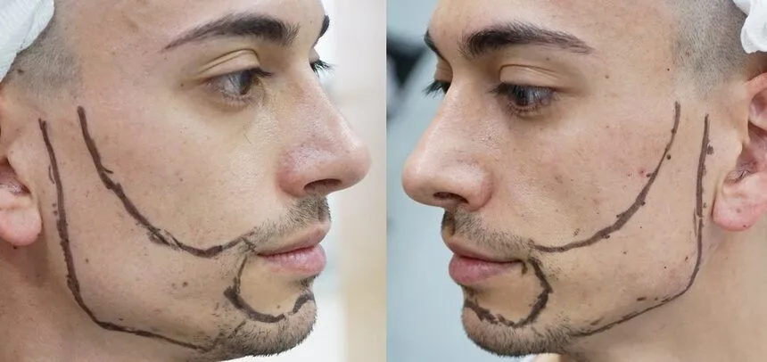 sakal kılıarının naklinin yapılacağı bölge kalemle işaretlenerek belirlenir.