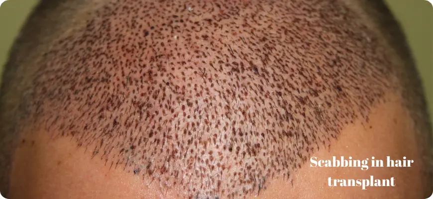 Scabs after hair transplant