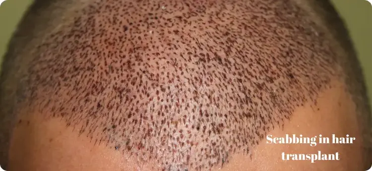Scabs after hair transplant