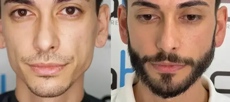 trapianto barba turchia