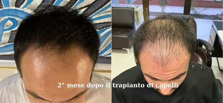 trapianto di capelli 2° mese