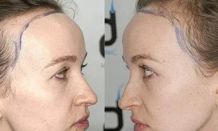 trapianto di capelli donna