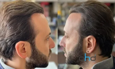 После пересадки волос