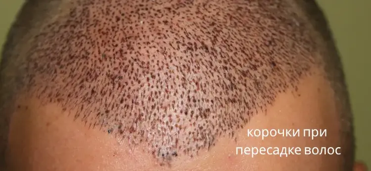 корочка после пересадки волос