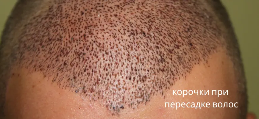 корочка после пересадки волос