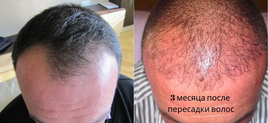 пересадка волос 3 месяца спустя