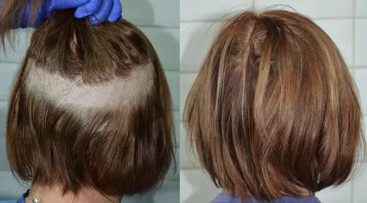 زراعة الشعر للنساء بطريقة عدم الحلاقة.