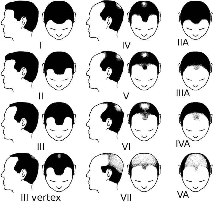 norwood scale