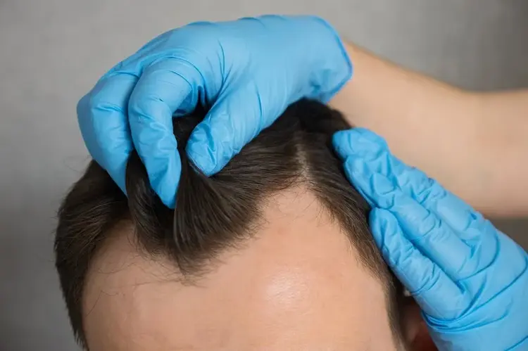 hair transplant oedema
