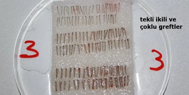donör bölgeden alınmış saç greftleri ( tekli , ikili, ve çoklu greftler)