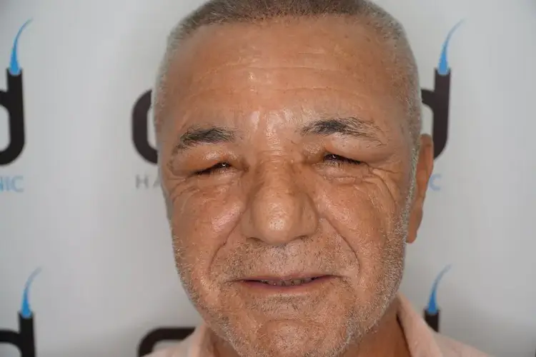 التورم (أو الانتفاخ) بعد زراعة الشعر