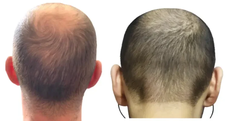 A donor who is not suitable for hair transplantation