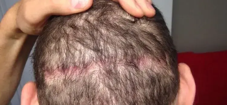 A candidate who is not suitable for a hair transplant